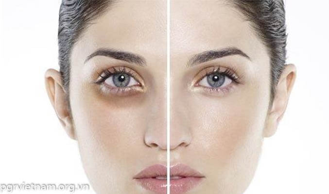 Trị thâm quầng mắt hiệu quả với kem trị thâm quầng mắt cach-lam-het-tham-quang-chi-sau-1-dem.JPG