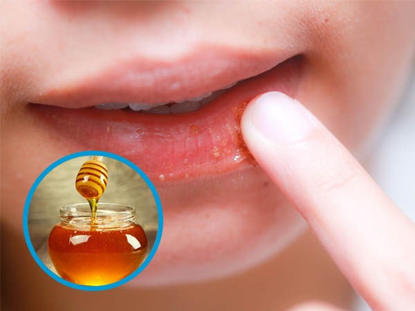 cach-tri-kho-moi-bang-mat-ong cach-tri-kho-moi-bang-mat-ong.jpg