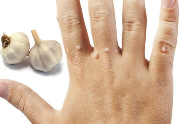 cach-tri-mun-coc-bang-toi-1 cach-tri-mun-coc-bang-toi.jpg