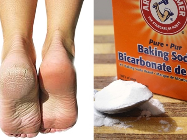 cach-tri-nut-got-chan-bang-baking-soda cach-tri-nut-got-chan-bang-baking-soda.jpg