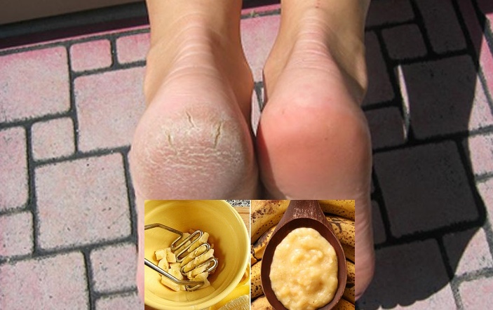 cach-tri-nut-got-chan-bang-chuo-1i cach-tri-nut-got-chan-bang-chuo-1i.jpg