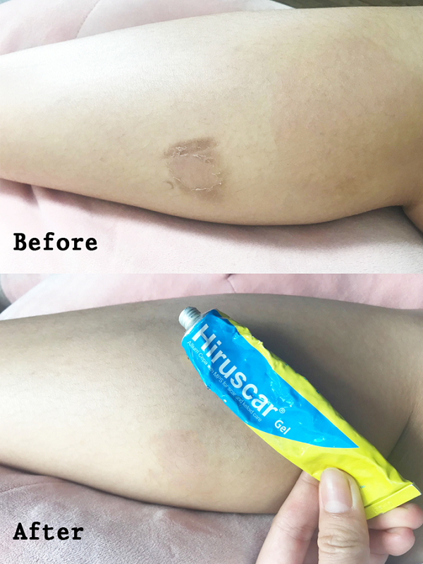 kem-tri-seo-hiruscar-3 kem-tri-seo-Hiruscar-3.png