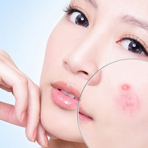 nguyen-nhan-gay-noi-mun-5 nguyen-nhan-gay-noi-mun-5.jpg