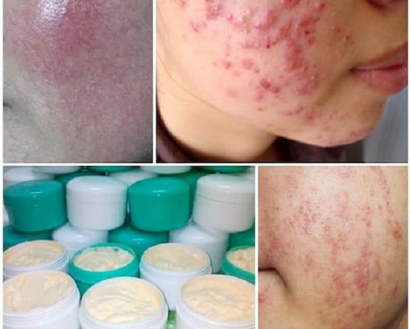 tac-hai-cua-my-pham-chua-corticoid Tac-hai-cua-my-pham-chua-corticoid.jpg