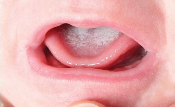 Nấm miệng ở trẻ sơ sinh là gì? Nguyên nhân và cách chữa nấm miệng ở trẻ sơ sinh hiệu quả