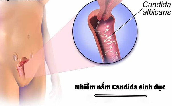 Nguyên nhân, triệu chứng và cách điều trị bệnh nấm Candida đường sinh dục