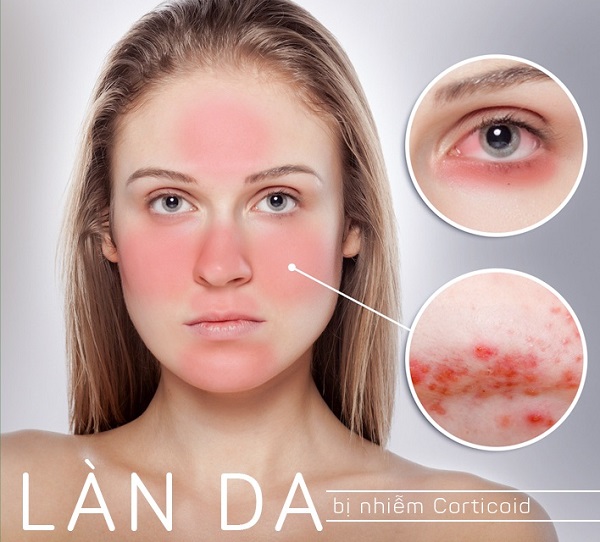 dau-hieu-da-nhiem-Corticoid.jpg