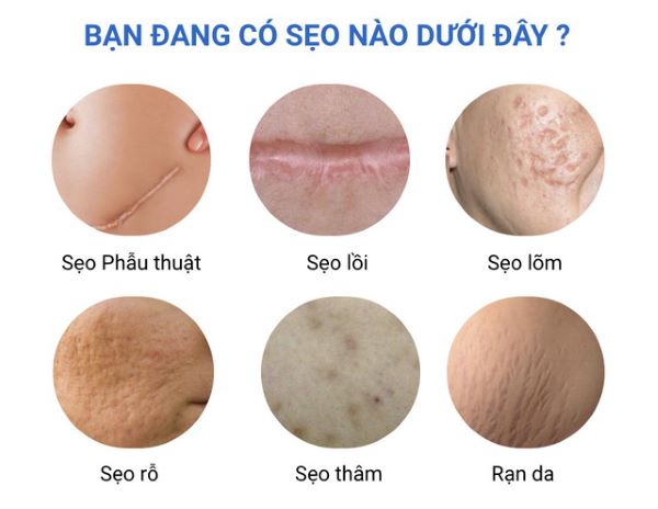 kem-tri-seo-tot-nhat.jpg